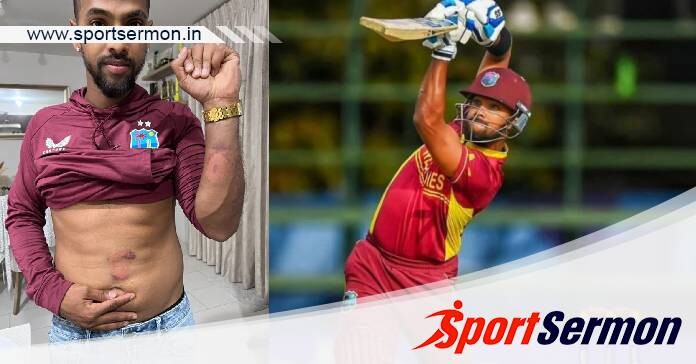 Fans shocked seeing cricketer Nicholas Pooran injuries  