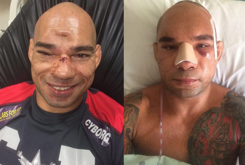 10 Most Horrifying Injuries In The History Of MMA  