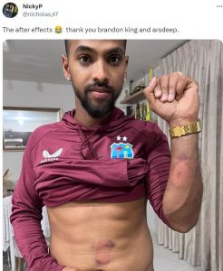 Fans shocked seeing cricketer Nicholas Pooran injuries  