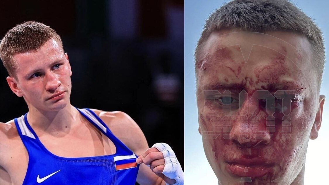 Russian Boxer Dmitry Dvali Sacrifices Sight to Save Child  